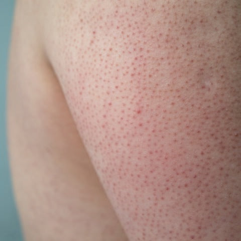 No More 'Strawberry Skin' - Banishing Keratosis Pilaris for Good!